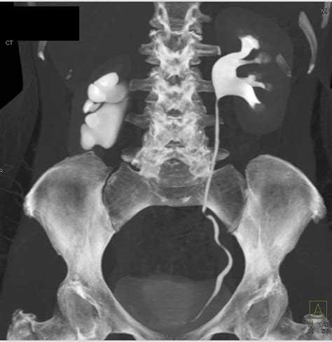 Ureteropelvic Junction Upj Obstruction Of The Right Kidney Kidney