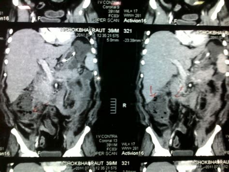 Dr Keyur S Bhatt Ms Mrcsed Case Minimal Invasive Lap Assisted