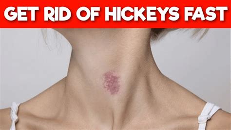 8 Ways To Get Rid Of Hickey In Minutes Youtube