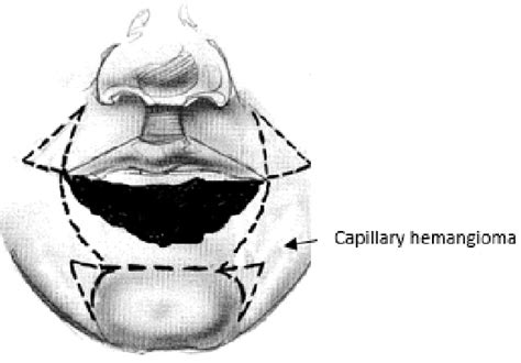 Figure 1 From Total Lower Lip Reconstruction By The Webster Bernard