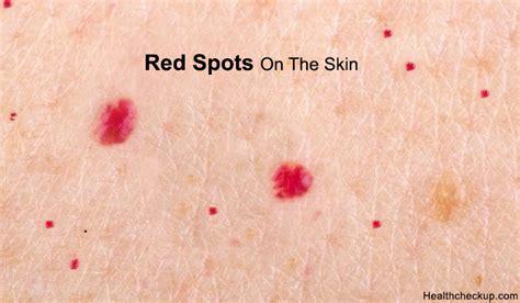 Spots On Skin