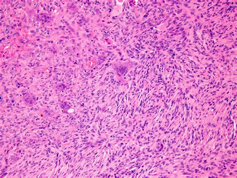 Pathology Outlines Giant Cell Tumor Of Bone NOS