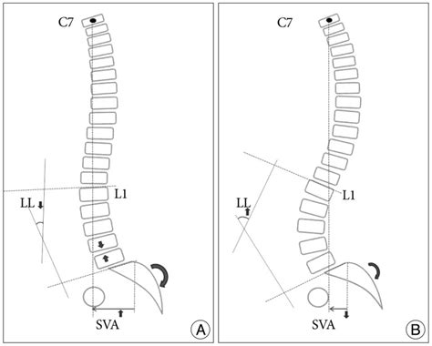 Illustration Showing The Difference Of Sagittal Spinopelvic Alignment