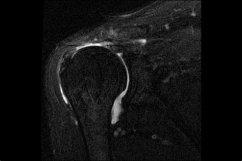 Ortho Dx Shoulder Pain Without Arthritis Clinical Advisor