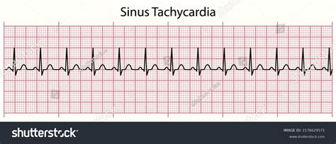 Ecg Line Sinus Tachycardia In Second Ecg Royalty Free Stock Vector