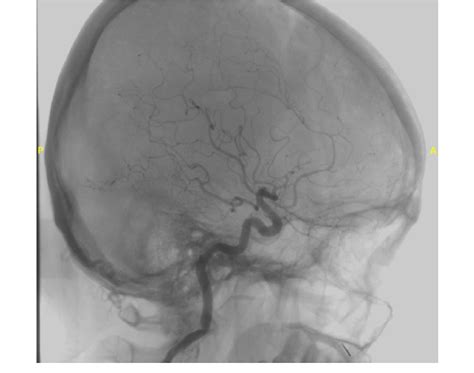 Angiogram Showing Dilated Superficial And Cortical Veins Mainly At The