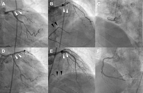 A Total Occlusion Of The Left Anterior Descending Coronary Artery