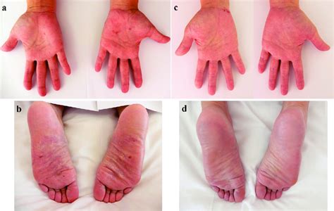 Skin Findings Of Palmoplantar Pustulosis On The Palms And Soles A