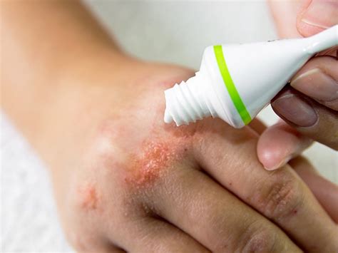 Rash On Hands Causes And When To See A Doctor