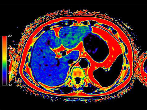 Free Breathing Abdominal Imaging Philips Mr Body Map