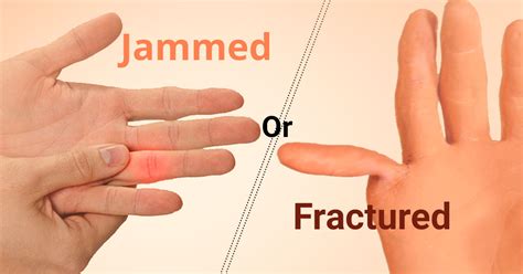 have you ever jammed or fractured your finger marhammarham