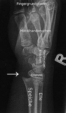 He was the son of the 1st baron beaverbrook. Epiphysiolyse - Wikipedia