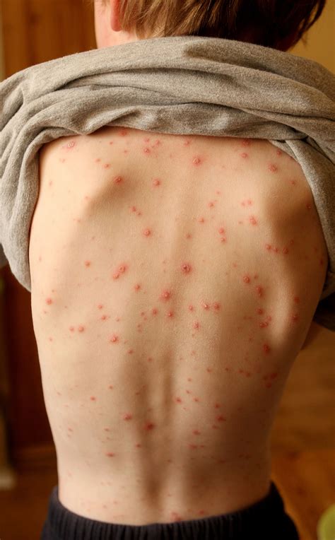 Skin Rash Should Be Considered Key Symptom Of Coronavirus Say Scientists