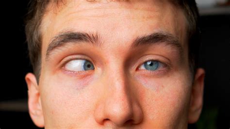 What Is Strabismus Eye Doctor Explains Doctor Eye Health