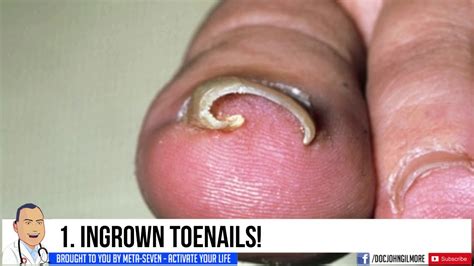 Most Popular Ingrown Tornails Cysts And Pimple Pops Keywords Youtube