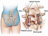 Posterior Lumbar Fusion Recovery Time Pictures