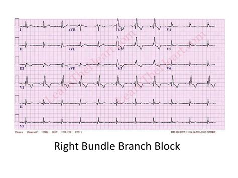 Sinus Rhythm With Right Bundle Branch Block