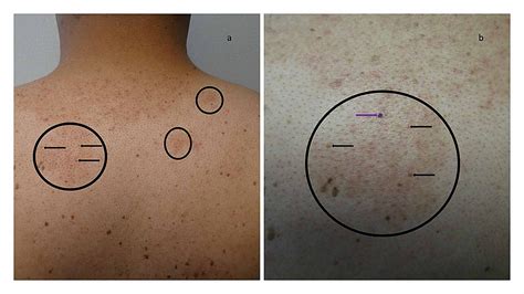 Cureus Malassezia Pityrosporum Folliculitis Incognito Malessezia