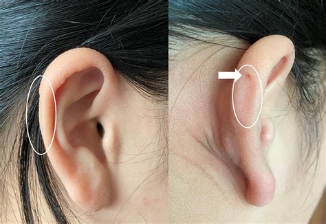 The Differences Between 2 Cases Of Preauricular Fistula Ye Jin Cho