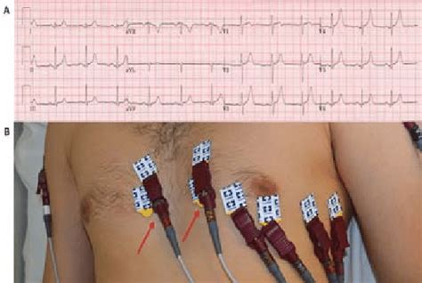 12 Lead Ecg Depicting V1 And V2 Placed In The Third