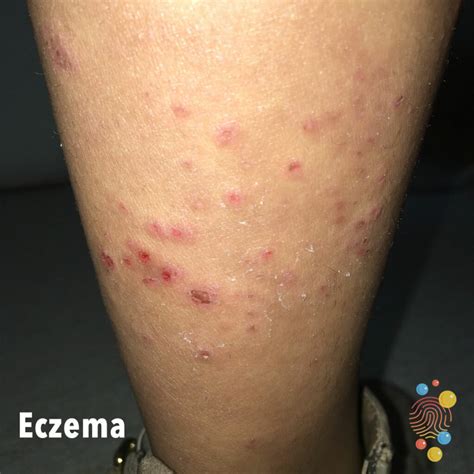 Top 98 Wallpaper Eczema Rash On Legs Pictures Superb 122023