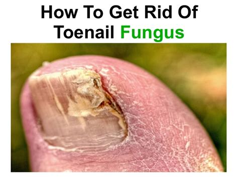 Removing Toenails To Get Rid Of Fungus Toenail Fungus Expert