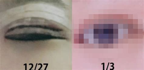 Korean Teen Reveals Step By Step Process Of Her Own Double Eyelid