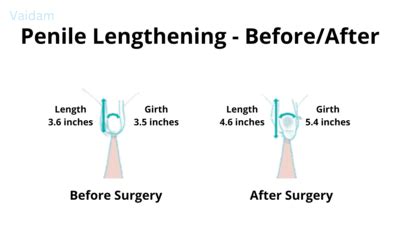 Penile Lengthening Cost In Thailand Updated