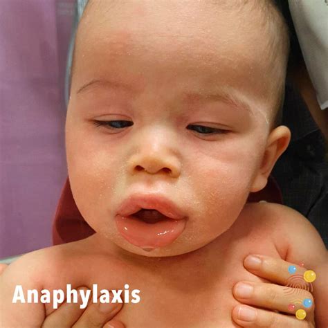 Anaphylaxis Skin Deep