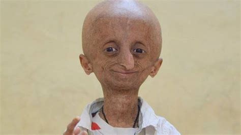 Nihal Bitla India Progeria Campaigner Dies Aged 15 Bbc News