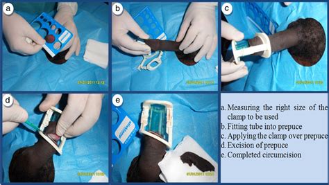Figure 1 From The Safety Profile And Acceptability Of A Disposable Male Circumcision Device In