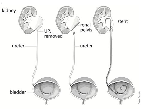 Laparoscopic Pyeloplasty Mr Isaac Thyer