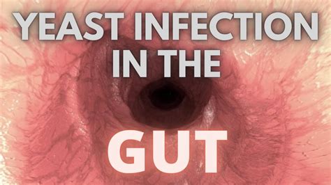 Gut Infections Could Be A Severe Yeast Infection Youtube
