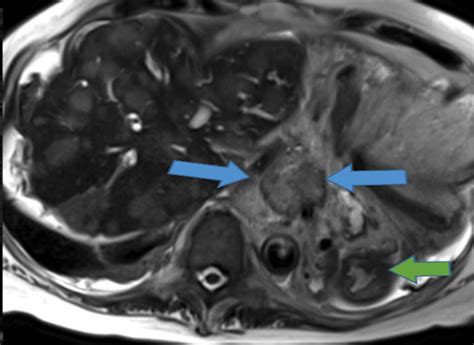 Axial T2 Mri Image Shows Pancreatic Mass Invading The Coeliac Axis