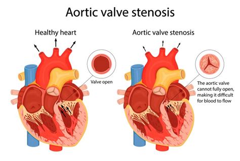 Aortic Stenosis Overview Tavr Or Tavi Add More To Life Meril