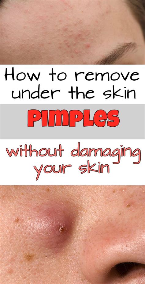 How To Remove Under The Skin Pimples Without Damaging Your