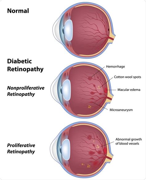 Diabetic Eye Disease Diabetic Retinopathy Stages
