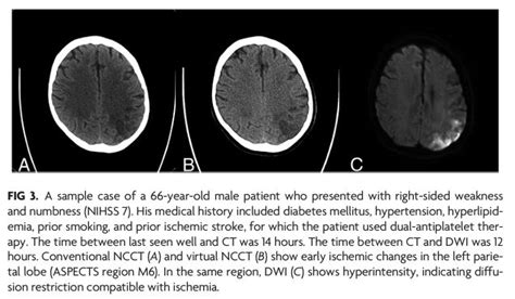 Ajnr On Twitter Detection Of Early Ischemic Changes With Virtual
