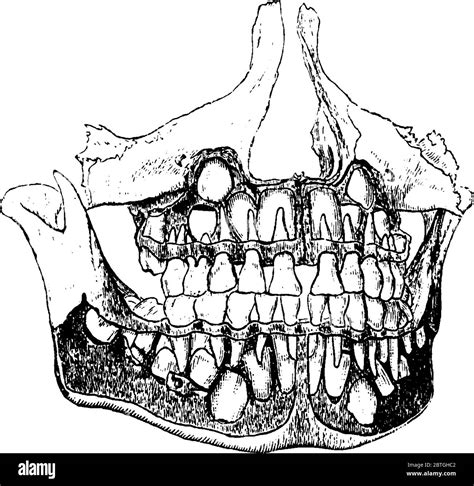 Diagram Of Baby Jaw Showing Both Temporary And Permanent Teeth Vintage