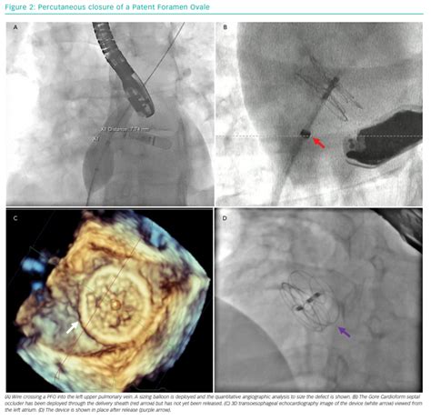 Percutaneous Closure Of A Patent Foramen Ovale Radcliffe Vascular