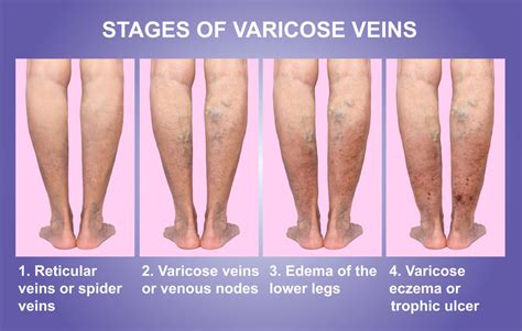 What Is The Difference Between Varicose Veins And Spider Veins