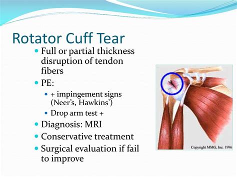 Ppt The Shoulder Evaluation And Treatment Of Common Injuries