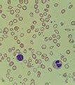 Category:Anemias - Wikimedia Commons