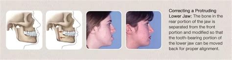 Corrective Jaw Surgery Orthognathic Surgery Jaw Misalignment Aaoms