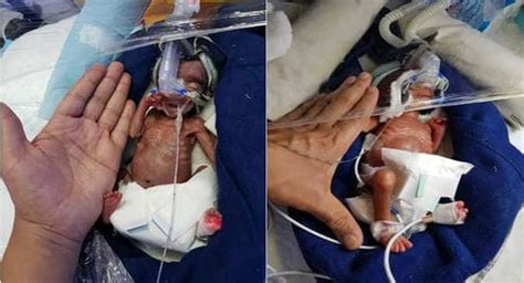 Miracle Premature Babies Weighing Just 475 Gm And 617 Gm Among The