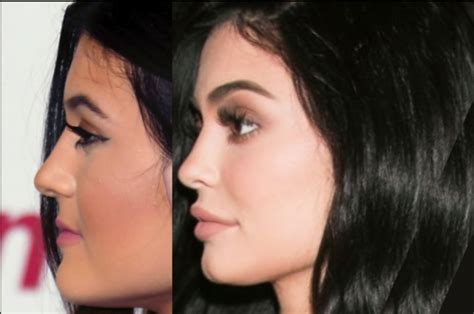 Kylie Jenner Before And After 😱 All Of Her Plastic Surgery