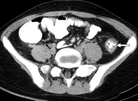 Bowel Wall Thickening In Children Ct Findings Radiographics