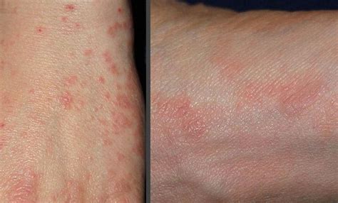 Pin On Skin Rashes Pictures