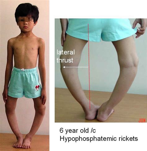 Hypophosphatemic Rickets Causes Symptoms Diagnosis Treatment And Prognosis