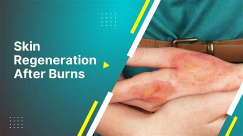Skin Regeneration After Burns Skin Healing After Burns 2024